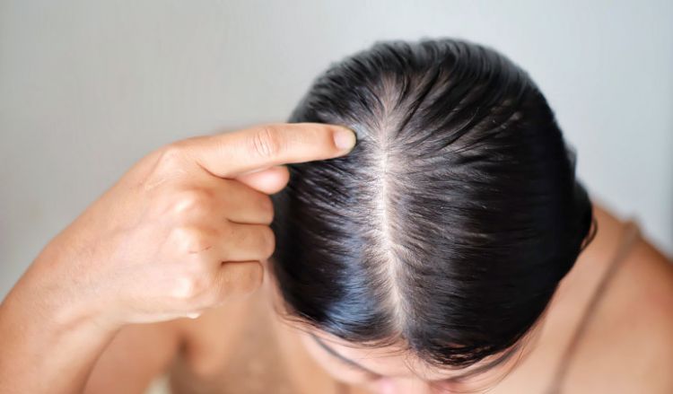 Hair Loss